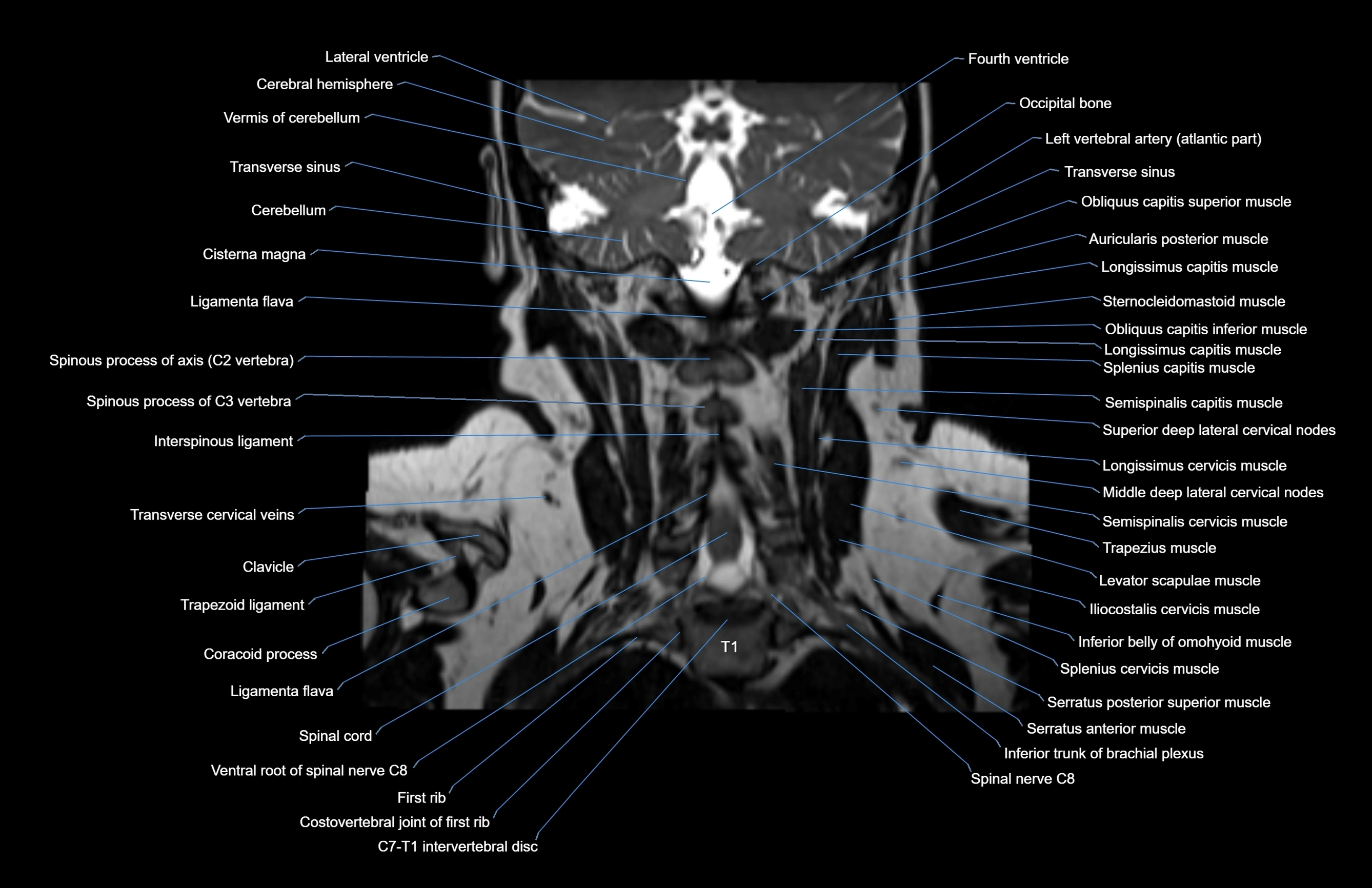 Neck coronal cross sectional MRI anatomy 3T MRI  image-img-00001-00020.webp